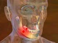 Un dinte bolnav poate provoca inflamația inimii