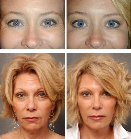 Botox sub ochii mărturiilor, recenzii, efecte, fotografii înainte și după, prețuri