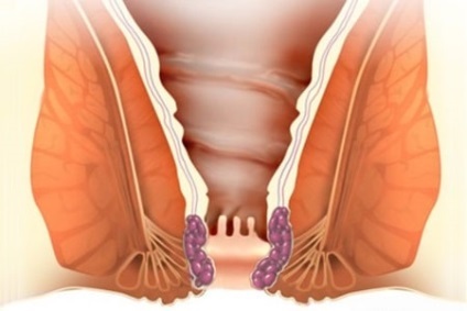 Cele mai periculoase hemoroizi sunt consecințele și complicațiile bolii