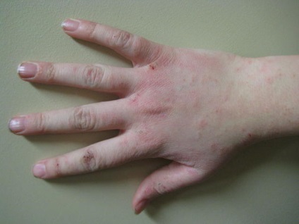 Ce trebuie să faceți dacă pielea se usucă pe mâini și crăpături