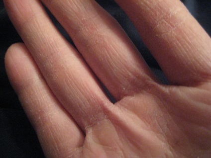 Що робити, якщо сохне шкіра на руках і тріскається
