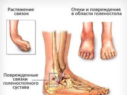 Ce trebuie făcut dacă piciorul este dislocat și care sunt simptomele dislocării gleznei?