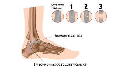 Ce trebuie făcut dacă piciorul este dislocat și care sunt simptomele dislocării gleznei?