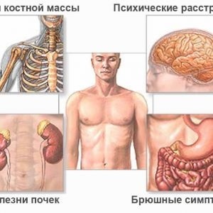 Що таке гиперпаратиреоз, симптоми і лікування, наслідки