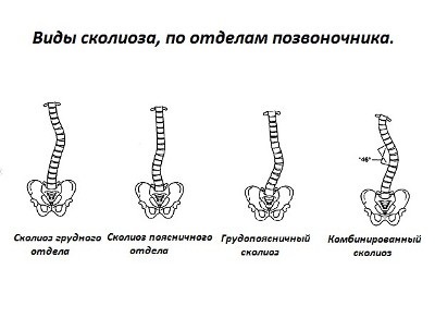 Ce este scolioza coloanei vertebrale?