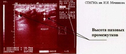 Diagnosticul herniilor abdominale la St. Petersburg - o pagină a Dr. Ivanov