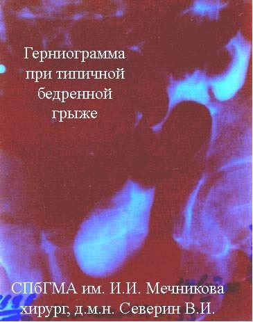 Diagnosticul herniilor abdominale la St. Petersburg - o pagină a Dr. Ivanov