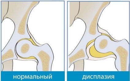 Дисплазія кульшового суглоба у новонароджених симптоми, лікування, причини