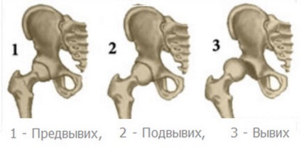 Дисплазія кульшового суглоба у новонароджених симптоми, лікування, причини