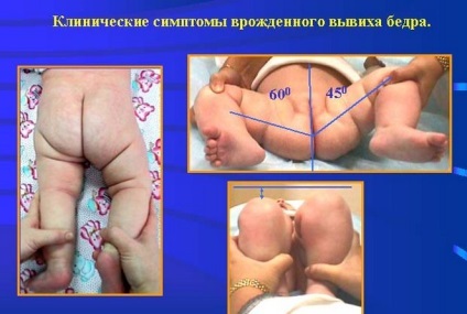 Дисплазія кульшового суглоба у новонароджених симптоми, лікування, причини