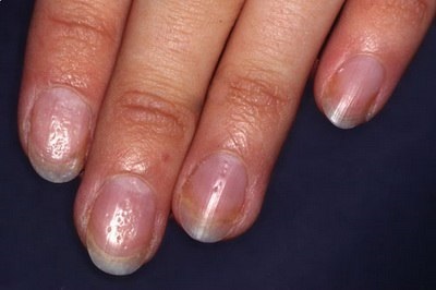 Дистрофія нігтів на руках - причини, різновиди і способи лікування