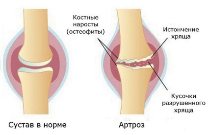 Ефективне лікування артрозу в Санкт-Петербурзі