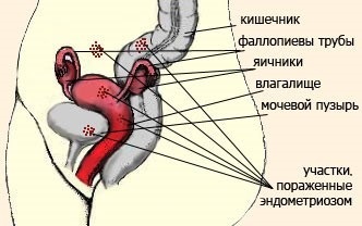 Endometrioza, miomul uterin, adenomioza