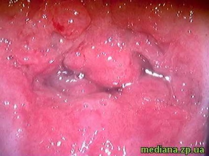 Eroziunea colului uterin după fotografie de livrare