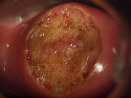 Eroziunea colului uterin după fotografie de livrare