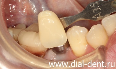Фізіологічні протезування зубів