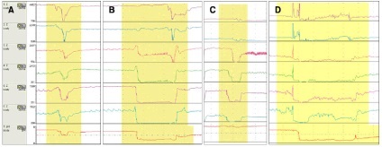 Reflux gastroesofagian (ger)