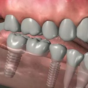 Де краще зробити імплантацію зубів і де дешевше