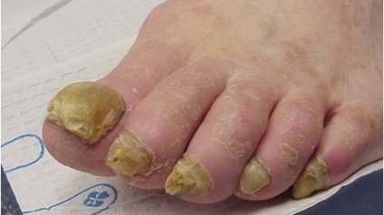 Köröm gomba az idősek, mint a gyógyítás - köröm gombás tünetek, kezelés, megelőzés, véleménye a (gomba) Köröm gomba az idősek, mint a gyógyítás - köröm gombás tünetek, kezelés, megelőzés, az értékelés