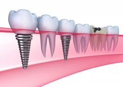 A fogászati ​​implantátumok Ufa, ár, vélemények