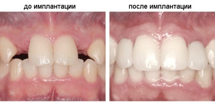 Імплантація зубів в Уфі, ціни, відгуки