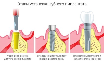 Implantarea de dinți în Ufa, prețuri, recenzii