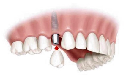 A fogászati ​​implantátumok Ufa, ár, vélemények