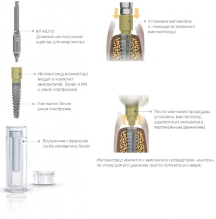 Implantátum hatlapú kapcsolat mis hét - MIS implantátum Oroszország i MIS implantátum