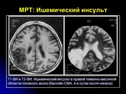 Infarctul vaselor cerebrale (accident vascular cerebral, cauzat de tromboza arterelor cerebrale) - ischemic,