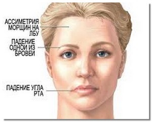 Accident vascular cerebral, simptome și primul ajutor pentru accident vascular cerebral, frumusete va salva lumea