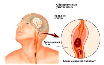 Інсульт запам'ятайте всього 3 перші кроки, щоб врятувати себе і близьким життя! Все для жінки (вдж)