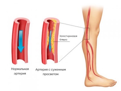 Ішемія нижніх кінцівок - причини, стадії, симптоми, діагностика, методи лікування і профілактика