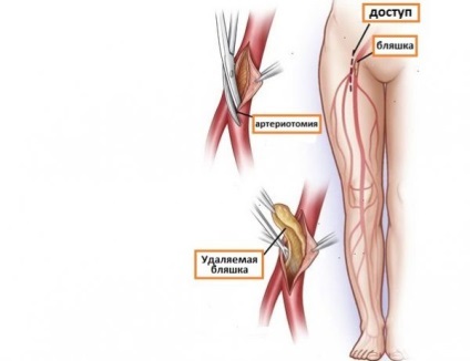 Ішемія нижніх кінцівок - причини, стадії, симптоми, діагностика, методи лікування і профілактика