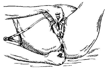 Măsurarea pelvisului, indicele notei, rhombus mihaelisa