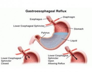 Pirozis cu boală de reflux gastroesofagian