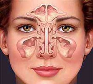 Mi a különbség az arcüreggyulladás származó arcüreggyulladás