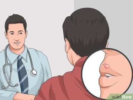 Hogyan kell kezelni a herpesz vagy hideg