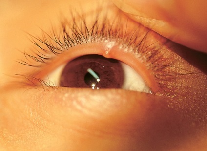 Cum se trateaza orzul pe ochi si cauzele aparitiei acestuia