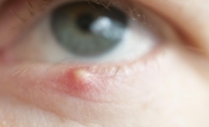 Як лікувати ячмінь на оці і причини його появи
