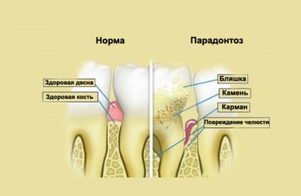 Як відбілити зуби самої в домашніх умовах - як відбілити зуби активованим вугіллям в домашніх