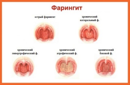 Як відрізнити ангіну від фарингіту основні симптоми, лікування