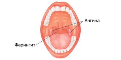 Cum să distingem angina de faringită, principalele simptome, tratamentul