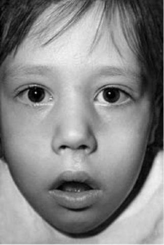 Cum să înțelegeți că un copil are metode adenoide de diagnostic, gât