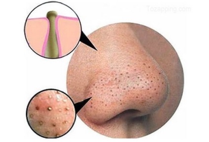Як прибрати розширені пори, пігментацію, судинну сітку на обличчі проблемна шкіра