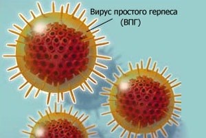 Як вилікувати герпес медикаменти і перевірені народні засоби