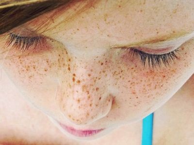 Як вилікувати пігментні плями на обличчі