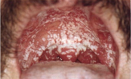 a garat candidiasis