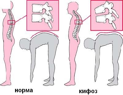 Kyphosis, ceea ce este, diagnosticul și tratamentul