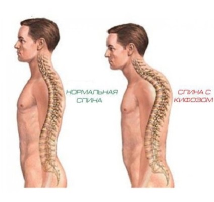 Kyphosis, ceea ce este, diagnosticul și tratamentul