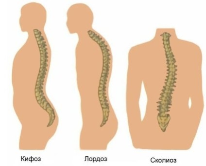 Kyphosis, ceea ce este, diagnosticul și tratamentul